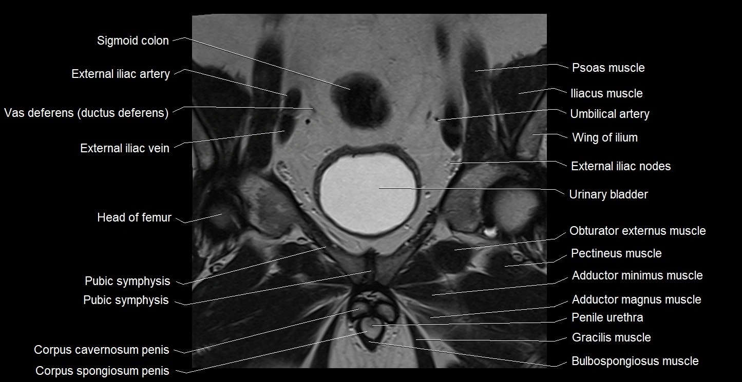 MRI coronal cross sectional anatomy male pelvis image 14.webp